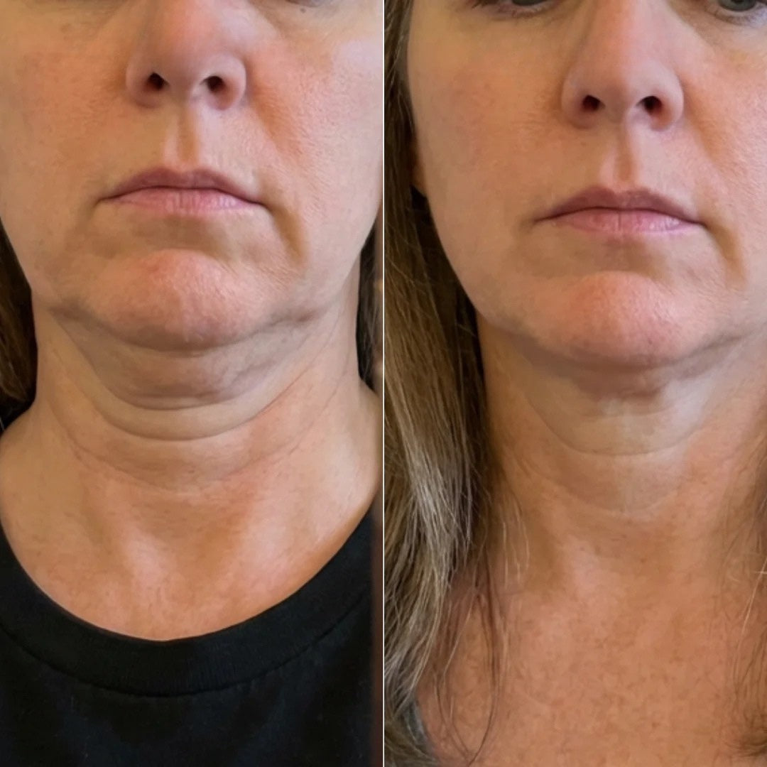 @catherine, 48 — original customer comparison photographs